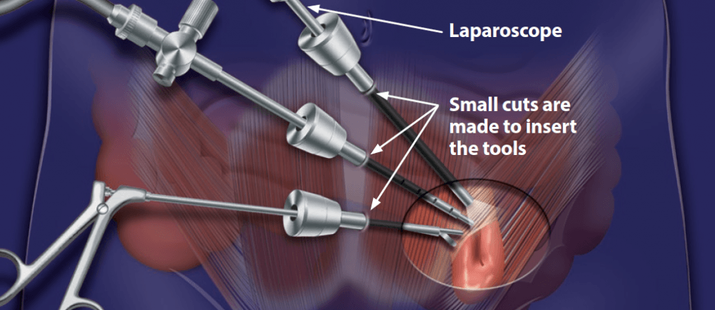 Individual undergoing a laparoscopic left inguinal hernia surgery