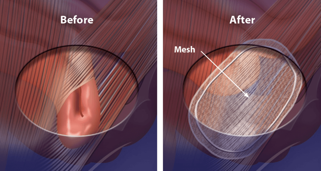 Inguinal hernia before and after hernia surgery using an open tension free mesh repair under local anaesthetic