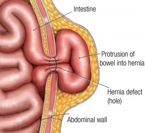 Side view of an umbilical hernia containing small intestine